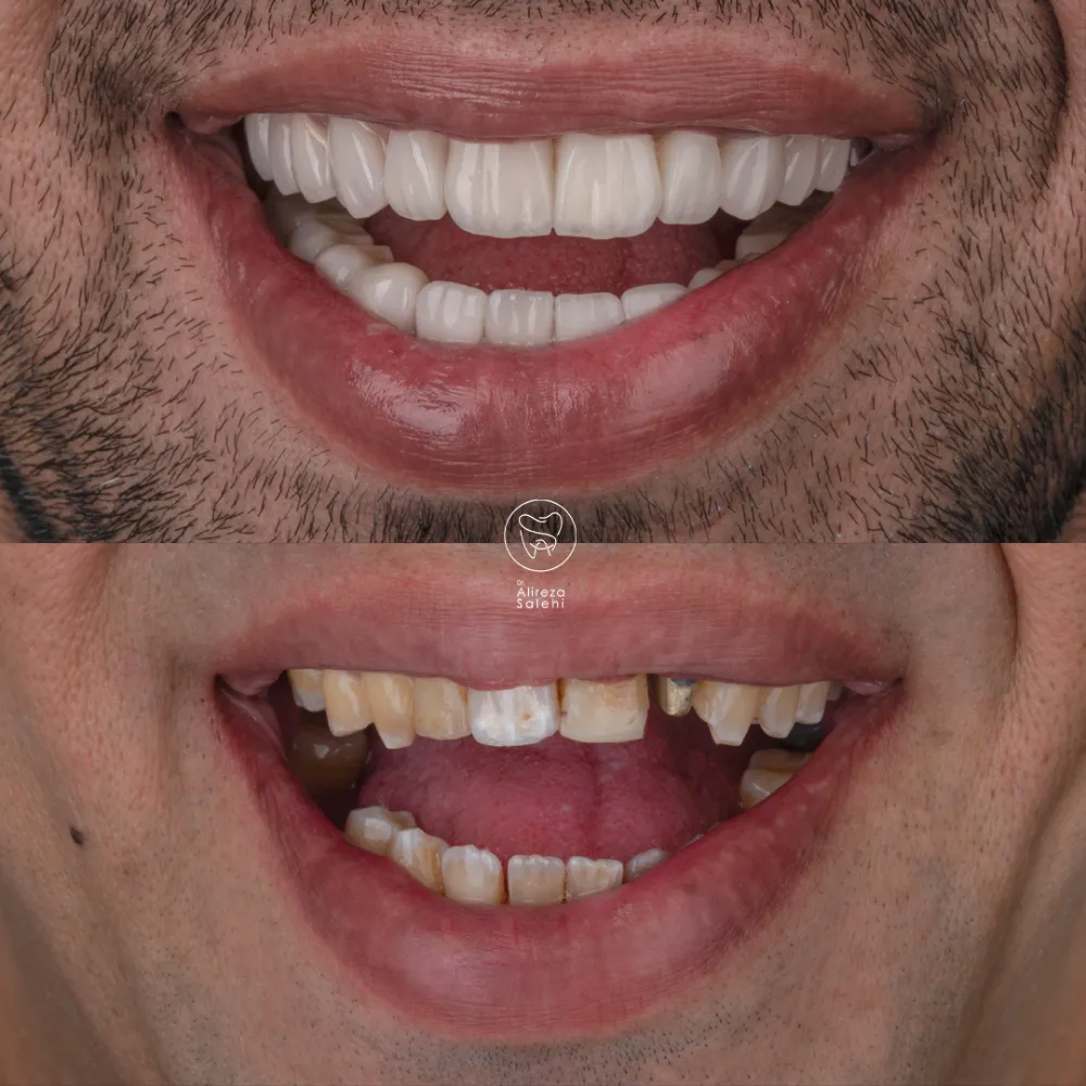 ایمپلنت دیجیتال