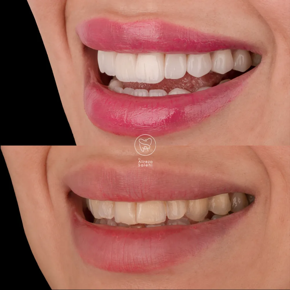 لمینت دیجیتال