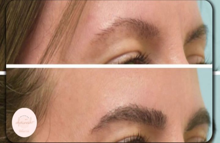 در این مقاله، به بررسی دقیق «نظرات کسانی که کاشت ابرو انجام دادهاند» میپردازیم تا با استفاده از تجربه واقعی افراد، از لحظه جراحی تا رشد کامل ابروها، مسیر را به زبان ساده تشریح کنیم. هدف ما آن است که اگر شما در حال بررسی روند کاشت هستید، با آگاهی کاملتر تصمیم بگیرید و بدانید در هر مرحله چه انتظارات منطقی باید داشته باشید. در این مسیر، خواهیم دید که مراحل کاشت ابرو چگونه طی میشود، چه نکاتی مشترک در نظرات کاربران دیده شده و چگونه میتوان به نتایج رضایتبخش دست یافت. ۱. چرا بررسی «نظرات کسانی که کاشت ابرو انجام دادهاند» مهم است؟ ۲. چارچوب زمانی: از جراحی تا رشد کامل در نظرات کاربران، تقریباً همه مراحل زیر دیده میشود و اشاره به آنها به شما کمک میکند روند را بهتر دنبال کنید. ۲.۱ جلسه مشاوره قبل از جراحی انتخاب کلینیک معتبر (بهعنوان مثال، کلینیک پوست و مو آفرینش بیوتی) که تخصص در کاشت ابرو دارد، از نکات مهم بوده است. تعیین ناحیه دهنده، تعداد گرافتها، طراحی طبیعی ابرو، بررسی سلامت عمومی و انتظارات بیمار اهمیت دارد. بسیاری از افراد ذکر کردهاند که مشاوره دقیق باعث شد آنها با آرامش بیشتری وارد روند شوند. ۲.۲ روز عمل و مراقبتهای اولیه در روز عمل معمولاً با بیحسی موضعی یا آرامبخش همراه است. سپس فولیکولها از ناحیهای از پوست سر برداشت شده و در منطقه ابرو کاشته میشوند. در این قسمت، دقت در زاویه کاشت، تراکم و جهت رشد بسیار مهم است. کاربران “نظرات کسانی که کاشت ابرو انجام دادهاند” اغلب به نکاتی مثل تورم، قرمزی، ترشحات یا خارش اشاره کردهاند که معمولاً موقتی است. ۲.۳ هفته اول پس از جراحی در این مرحله، اکثر افراد تجربه میکنند که موهایی که کاشته شدهاند، ممکن است بیفتند. این امر طبیعی است و بخشی از فرآیند است. توصیه شده است فعالیتهای شدید، شنا، ورزش سنگین و آرایش ابرو تا حداقل ۱-۲ هفته محدود شود. بسیاری گفتهاند که رعایت دقیق دستورالعملهای پزشک باعث شده دوره بهبود راحتتر طی شود. ۲.۴ ماه ۱ تا ۳: شکلگیری اولیه رشد در این مرحله، موهایی که کاشته شدهاند شروع به رشد میکنند اما ممکن است نازک باشند یا جهت رشد کمی متفاوت باشد. کاربران در «نظرات کسانی که کاشت ابرو انجام دادهاند» ذکر کردهاند که صبر کردن و عدم کشیدن یا مرتب کردن زودهنگام، مهم است. طبق مطالعه این نکته تأیید شده است که نرخ بقا (survival rate) فولیکولها و جهت صحیح رشد از عوامل کلیدی نتیجه پایدار هستند. ۲.۵ ماه ۴ تا ۶: رشد قابل رویت این مرحله، زمان رسیدن به تراکم قابلقبول و حالت طبیعیتر است. برخی کاربران گزارش دادهاند که در این مرحله بیشتر شبیه ابروهای طبیعی شدهاند و مراقبتها کمتر سخت است. همچنین گفته شده که در این ماهها ممکن است موهای کاشته شده رشد بلندتر از حد ابرو شوند و نیاز به کوتاهی پیدا کنند (چون از پوست سر برداشت شدهاند). ۲.۶ ماه ۶ تا ۱۲: نتیجه نهایی و تثبیت رشد اکثریت نظرات مثبت مربوط به این مرحله است: جایی که نتیجه ظاهر طبیعیتر، تراکم مناسبتر و آرامش ذهنی بیشتر است. مطالعهای نشان داد که ۹۱٪ بیماران پس از مدتی از نتیجه راضی بودهاند. در این مرحله ممکن است نیاز به تنظیمات نهایی (مثل کوتاهی، رنگ یا مرتبسازی) وجود داشته باشد اما روند اصلی به پایان رسیده است. ۲.۷ نکات بلندمدت پس از رشد کامل ابروهای کاشتهشده معمولاً دائمی هستند و نیاز به ترمیم مکرر ندارند. با این حال، مراقبتهای نگهداری مثل کوتاهی مرتب، حفظ سلامت پوست و اجتناب از کشیدگی یا آسیب به منطقه ابرو، توصیه شده است. در «نظرات کسانی که کاشت ابرو انجام دادهاند» آمده است که احساس اعتمادبهنفس بیشتر و رضایت از ظاهر تا سالها باقی مانده است. ۳. نکات مشترک در نظرات کاربران — چه چیزهایی بیشتر ذکر شده؟ در تحلیل «نظرات کسانی که کاشت ابرو انجام دادهاند»، چند نکته تکراری و کلیدی به چشم میخورد که آنها را در این بخش به شکل خلاصه و روان آوردهایم: ۳.۱ طراحی طبیعی ابرو اهمیت دارد کاربران اشاره کردهاند که طراحی ابرو قبل از عمل (شکل، ارتفاع، رنگ، جهت رشد) بسیار مهم است. اگر طراحی زیبا و متناسب با چهره نباشد، حتی با رشد خوب هم از نتیجه راضی نبودهاند. ۳.۲ تخصص پزشک و تجربه کلینیک قابلتوجه است انتخاب کلینیکی که تجربه، نمونه کار زیاد و تخصص در کاشت ابرو دارد، یکی از اصلیترین عوامل رضایت بالا بوده است. مطالعه نظاممند در این زمینه نشان داده است که کیفیت جراحی برای نتیجه بسیار تعیینکننده است. ۳.۳ مراقبتهای بعد از عمل را جدی بگیرید نظرات کاربران نشان میدهد که افرادی که دقیق تربه دستورالعملها عمل کردهاند (مثل عدم لمس منطقه، خوابیدن با زاویه مناسب، عدم ورزش سنگین، رعایت بهداشت) نتیجه بهتری داشتهاند. همچنین در مقاله Healthline آمده است: «باید از پزشک خود بخواهید دستورالعمل بعد از عمل را کامل توضیح دهد و آن را با دقت اجرا کنید.» ۳.۴ انتظار معقول داشته باشید بسیاری از کاربران میگویند که اگر انتظارشان خیلی سریع شدن رشد یا تراکم فوقالعاده بود، بعداً دچار ناامیدی شدند. مهم است بدانید «مراحل کاشت ابرو» زمان میبرد و رشد کاملاً طبیعی ممکن است حتی تا ۱۲ ماه طول بکشد. ۳.۵ نتیجه باعث افزایش رضایت و اعتمادبهنفس میشود بسیاری از کسانی که جراحی را با موفقیت انجام دادهاند، گفتهاند که احساس زیباتر و راحتتر در آرایش و زندگی روزمره دارند. این نکته در نظرات متعدد دیده شده و نشاندهنده تأثیر روانی مثبت این روند است. ۳.۶ هزینه و انتخاب درست را نباید فدای ارزان بودن کرد در بین نظرات کاربران، کسانی که هزینه را به عنوان معیار اصلی انتخاب کردهاند، گاهی دچار نتایج ضعیف شدهاند یا نیاز به ترمیم افزوده پیدا کردهاند. مقاله Healthline نیز هشدار میدهد: «هیچگاه از ارائهدهنده بیاعتبار برای صرفهجویی در هزینه استفاده نکنید.» ۴. معرفی معتبرترین و بزرگترین کلینیک کاشت ابرو در ایران، یکی از مراکز معتبر که در زمینه کاشت ابرو و آموزش تخصصی فعالیت دارد، کلینیک پوست و مو آفرینش بیوتی میباشد. این کلینیک با بهرهگیری از تیم متخصص، تجهیزات پیشرفته و روشهای بهروز، در میان متقاضیانی که بررسی «نظرات کسانی که کاشت ابرو انجام دادهاند» را انجام دادهاند، بسیار مثبت ارزیابی شده است. ویژگیهای کلینیک پوست و مو آفرینش بیوتی استفاده از تکنیکهای نوین و استاندارد کاشت ابرو مشاوره تخصصی و طراحی شخصیسازیشده مطابق با نوع چهره و مو پیگیری بعد از عمل و ارائه خدمات نگهداری تا رسیدن به نتیجه نهايي نمونه کارهای واقعی و دیدهشده که اعتماد کاربران را جلب کرده است اگر در حال تصمیمگیری برای کاشت ابرو هستید، بازدید از این کلینیک و بررسی نمونه کار و نظرات سایر مراجعان میتواند اقدام بسیار منطقی باشد. ۵. مراحل کاشت ابرو — بهطور خلاصه برای شفافیت، در این بخش مرور اجمالی بر «مراحل کاشت ابرو» ارائه میدهیم تا بدانید در هر مرحله چه اتفاقی میافتد: مشاوره و طراحی ابرو برداشت فولیکول از ناحیه دهنده آمادهسازی و کاشت فولیکولها در ابرو (با دقت زاویهگذاری، تراکم و جهت رشد) مراقبت اولیه بعد از عمل ریزش اولیه فولیکولهای کاشتهشده رشد اولیه موها (ماه ۱ تا ۳) رشد بیشتر و طبیعیتر شدن (ماه ۴ تا ۶) تثبیت کامل نتیجه (ماه ۶ تا ۱۲ و فراتر) نگهداری بلندمدت و مراقبتهای جانبی ۶. نکات تخصصی و علمی که از «نظرات کسانی که کاشت ابرو انجام دادهاند» استخراج شدهاند ۶.۱ نرخ بقا و جهت رشد فولیکولها مطالعات نشان میدهند که حفظ جهت رشد، زاویه صحیح و کیفیت فولیکولها، کلید موفقیتاند. ۶.۲ نقش تجربه جراح و تعداد گرافت یک مطالعه نشان داده است که استفاده از گرافتهای دو یا سهتایی در مقایسه با تکتایی، نتیجه بهتری از لحاظ تراکم و ظاهر طبیعی داده است. ۶.۳ مراقبت از ناحیه دهنده اگر برداشت فولیکول بهدرستی انجام نشود یا پوست دهنده آسیب ببیند، ممکن است نتیجه کمتر مطلوب شود. ۶.۴ زمان ریزش و رشد مجدد طبق منابع مختلف، ریزش اولیه فولیکولها طبیعی است و رشد مجدد معمولاً از ۳ ماه پس از جراحی شروع میشود. ۶.۵ انتظار واقعبینانه از نتیجه نتایج کامل ممکن است تا ۱۲ ماه طول بکشند؛ بنابراین افراد باید صبر داشته باشند و تحت فشار زمانی قرار نگیرند. ۶.۶ عوارض احتمالی اگرچه نادرند، اما عوارضی مثل فولیکولیت، اسکار و جهت ناصحیح رشد دیده شدهاند. ۶.۷ هزینه، اثر طولانیمدت و تصمیم هوشمندانه با وجود هزینه بالاتر نسبت به تکنیکهای موقت، کاشت ابرو یک راهحل بلندمدت است و بررسی دقیق کلینیک و تیم جراحی توصیه شده است. ۷. چه کسانی گزینه مناسب برای کاشت ابرو هستند؟ افرادی که به دلیل دلایلی مثل ژنتیکی، برداشتن مکرر ابرو، سوختگی یا آسیب دچار ریزش ابرو شدهاند. کسانی که انتظارات واقعی دارند و حاضرند زمان لازم برای رشد را صرف کنند. افرادی که سلامت عمومی خوبی دارند و کاندیدای مناسبی برای جراحی هستند. کسانی که حاضرند هزینه و مراقبت لازم را بپردازند و برای نتیجه بلندمدت برنامهریزی کنند. جمعبندی علمی بر اساس تحلیل «نظرات کسانی که کاشت ابرو انجام دادهاند»، میتوان نتیجه گرفت که این فرآیند اگر در کلینیک معتبر (مثل کلینیک پوست و مو آفرینش بیوتی) و با تیم متخصص انجام شود، نتایج بسیار رضایتبخشی دارد. نکات کلیدی برای موفقیت عبارتند از: انتخاب دقیق طراح ابرو، اجرای درست مراحل کاشت ابرو، پیگیری مراقبتهای بعد از عمل، داشتن صبر کافی تا رسیدن به رشد کامل و انتظار معقول. بهطور خلاصه، کاشت ابرو میتواند یک سرمایهگذاری زیبایی و اعتمادبهنفس بلندمدت باشد، بهشرط آنکه با آگاهی و انتخاب درست انجام شود. سوالات متداول سوال ۱: پس از کاشت ابرو چه زمانی میتوانم نتیجه قابلمشاهده داشته باشم؟ پاسخ: معمولاً ریزش اولیه موهای کاشتهشده در هفتههای اولیه اتفاق میافتد، و رشد جدید موها از حدود ماه ۳ آغاز میشود؛ تراکم و ظاهر طبیعی کامل ممکن است تا ماه ۶ تا ۱۲ بهبود یابد. سوال ۲: کاشت ابرو چه مراقبتهایی بعد از عمل نیاز دارد؟ پاسخ: از جمله مراقبتهای معمول: خودداری از لمس منطقه، خوابیدن با زاویه مناسب، اجتناب از ورزش سنگین یا شنا، استفاده از داروها/کرمهای تجویزی، و مراجعه دورهای به پزشک برای بررسی پیشرفت. سوال ۳: آیا نتیجه کاشت ابرو دائمی است؟ پاسخ: بله، با توجه به استفاده از فولیکولهای واقعی بدن خود فرد (عموماً از پوست سر)، نتیجه دائمی و بلندمدت است؛ اما نگهداری و مراقبتهای جانبی لازم است. سوال ۴: آیا انتخاب کلینیک و جراح مهم است؟ پاسخ: بسیار مهم است. در «نظرات کسانی که کاشت ابرو انجام دادهاند»، افراد بسیار به تجربه جراح، طراحی اولیه و تخصص تیم اشاره کردهاند. انتخاب نامناسب ممکن است منجر به نتایج ضعیف شود. سوال ۵: آیا کاشت ابرو برای همه مناسب است؟ پاسخ: نه لزوماً. کسانی که سلامت کافی ندارند، انتظارات غیرواقعی دارند یا مراقبت بعد از عمل را جدی نمیگیرند ممکن است گزینه مناسبی نباشند. مشاوره تخصصی قبل از عمل بسیار توصیه میشود.